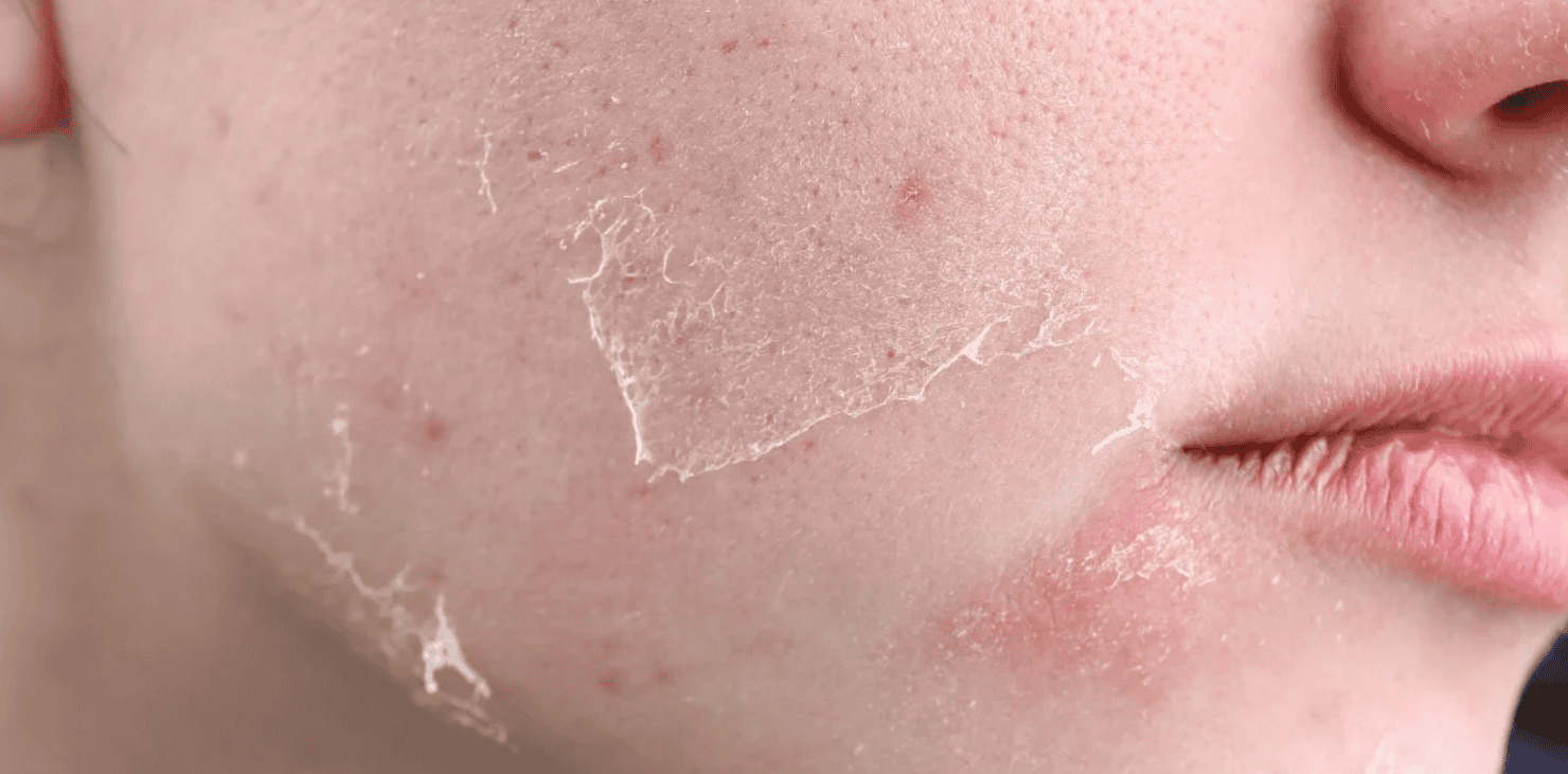 da mặt khô nứt nẻ phải làm sao​ hình 2.png