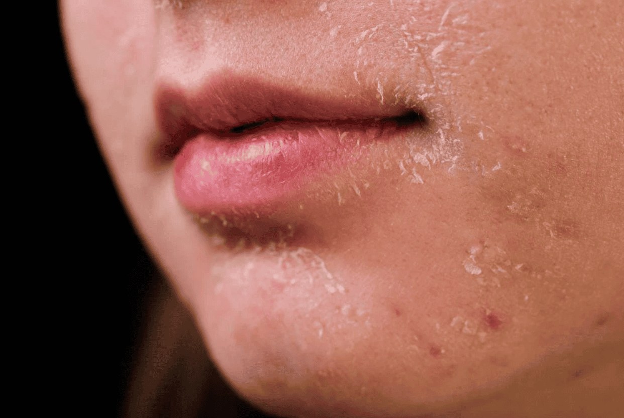 da mặt khô nứt nẻ phải làm sao​ hình 6.png