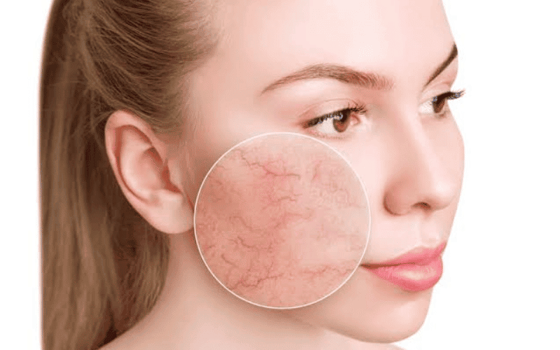 Người có da mỏng thường xuyên gặp tình trạng da đỏ mặt khi tiếp xúc với ánh nắng, thời tiết nóng lạnh thất thường hoặc sau khi sử dụng mỹ phẩm