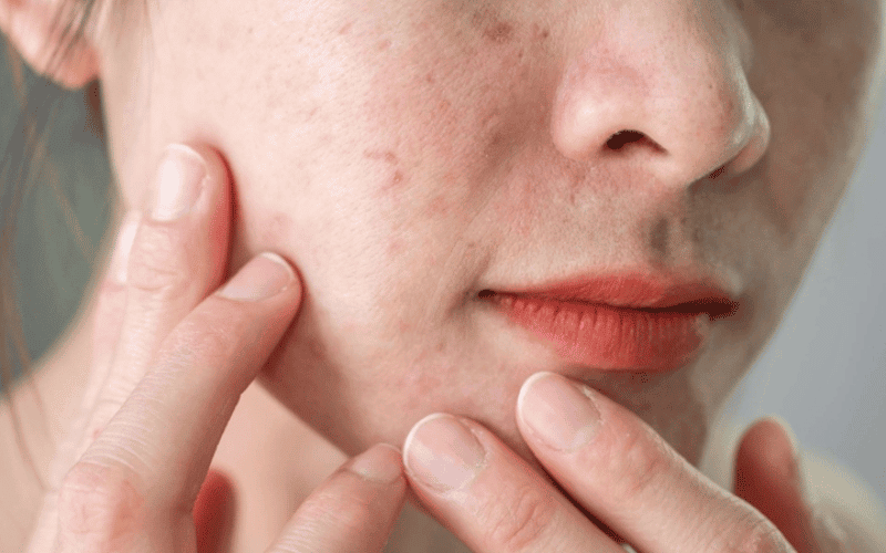 Các vấn đề da liễu kéo dài như mụn viêm, viêm da, kích ứng hoặc dị ứng tái diễn nhiều lần cũng có thể khiến da bị tổn thương