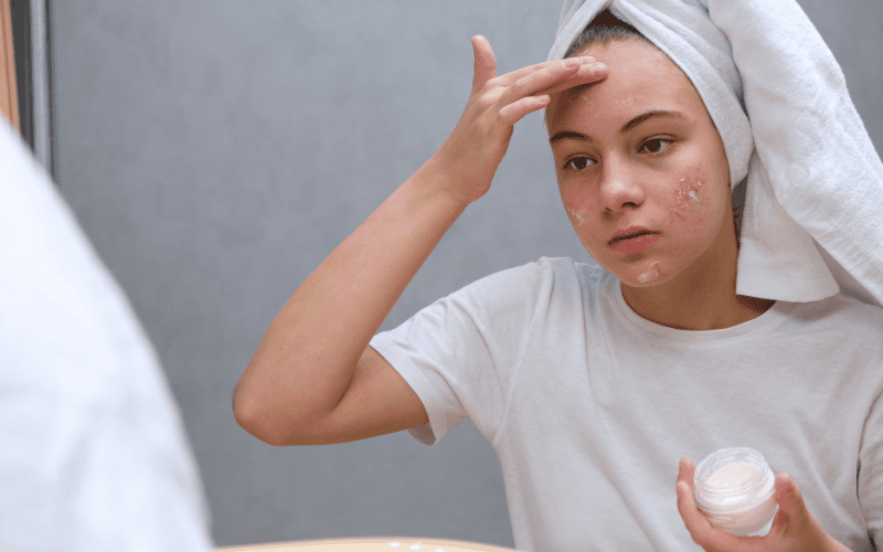 theo các chuyên gia da liễu, da mụn càng cần được chống nắng hằng ngày