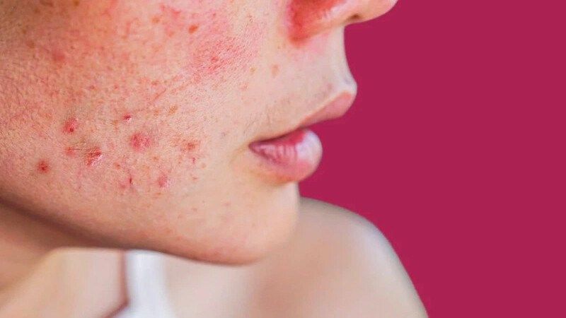 Làn da nhạy cảm dễ bị kích ứng bởi hương liệu, cồn và các thành phần hóa học mạnh