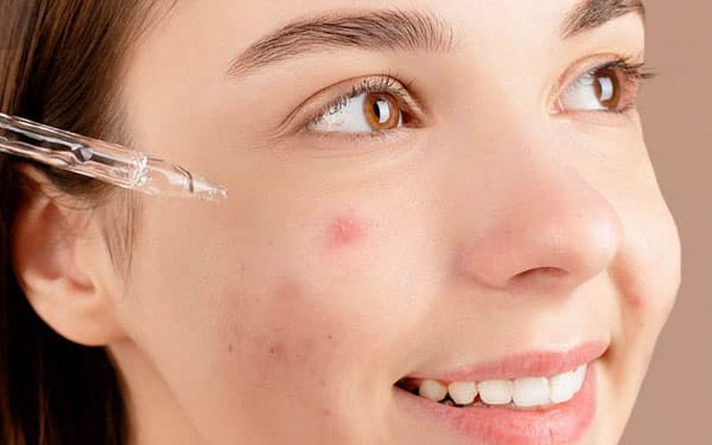 Câu trả lời là CÓ, bạn nên dùng serum khi đang bị mụn, nhưng với điều kiện là bạn phải chọn đúng loại serum và sử dụng đúng cách.