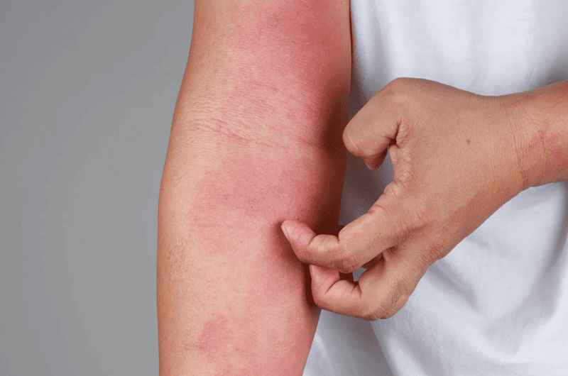 Mặc dù ít phổ biến hơn, nhưng trong một số trường hợp dị ứng kem chống nắng nghiêm trọng, phản ứng có thể không chỉ giới hạn ở vùng da tiếp xúc mà còn ảnh hưởng đến toàn bộ cơ thể