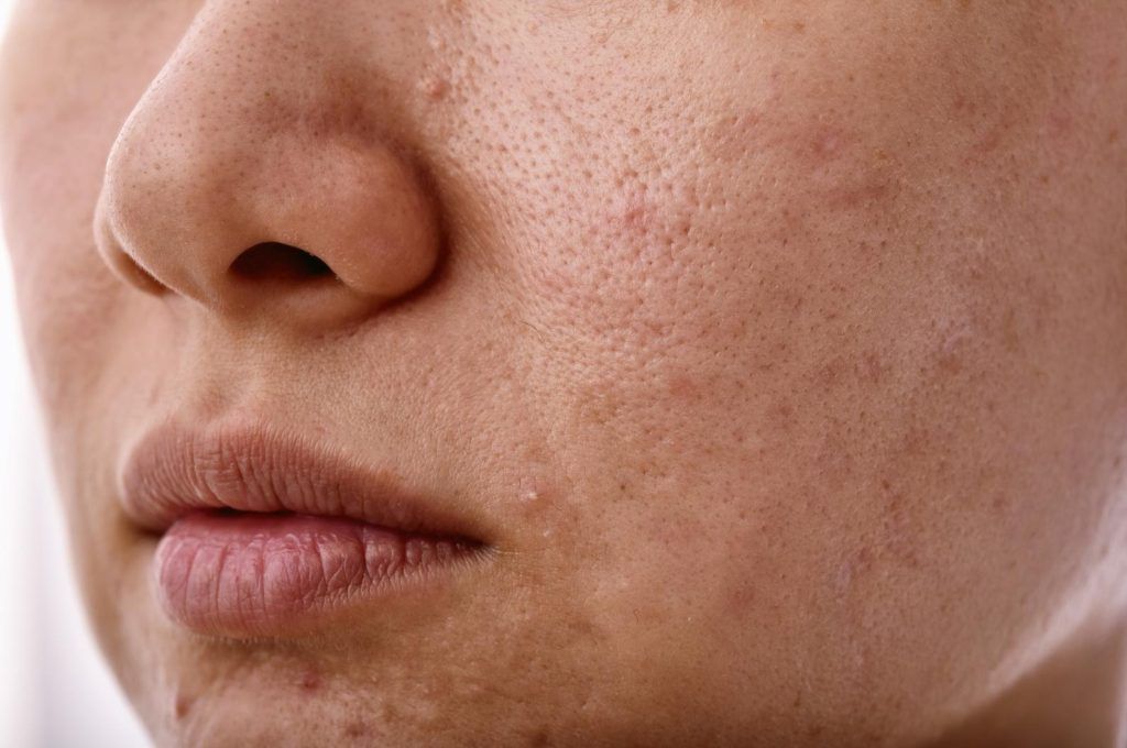 dùng nước tẩy trang thay sữa rửa mặt được không hình 3.jpg