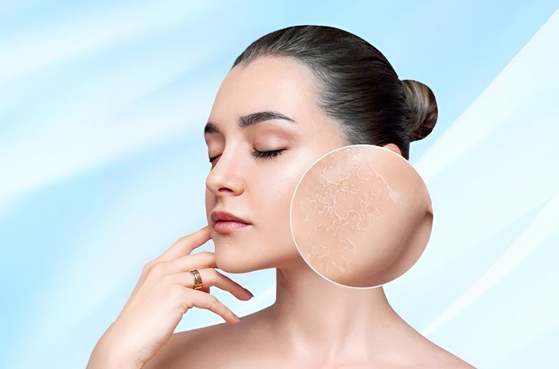 Da khô là tình trạng da sản xuất ít dầu hơn mức bình thường, dẫn đến thiếu hụt lipid cần thiết để duy trì độ ẩm