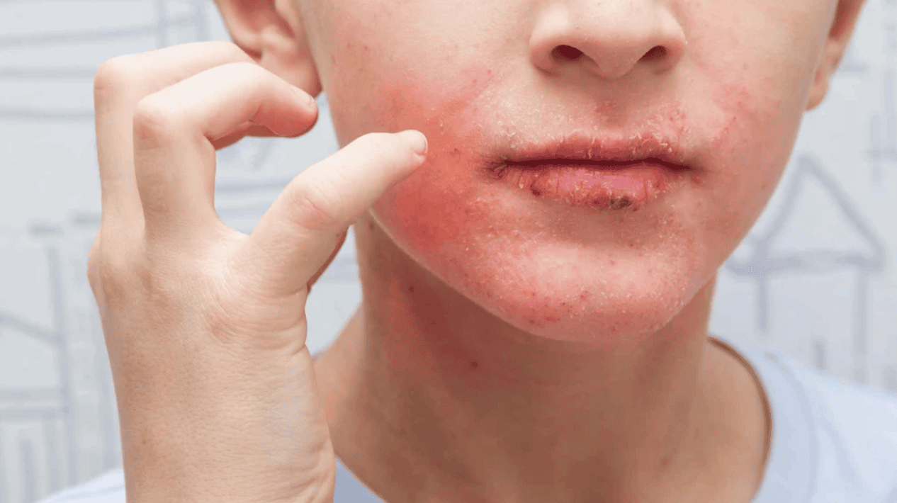 phục hồi hàng rào bảo vệ da hình 3.png