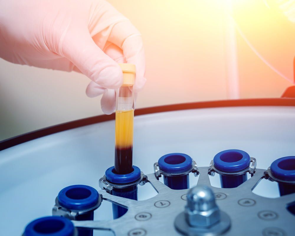 PRF hay còn gọi là Fibrin giàu tiểu cầu