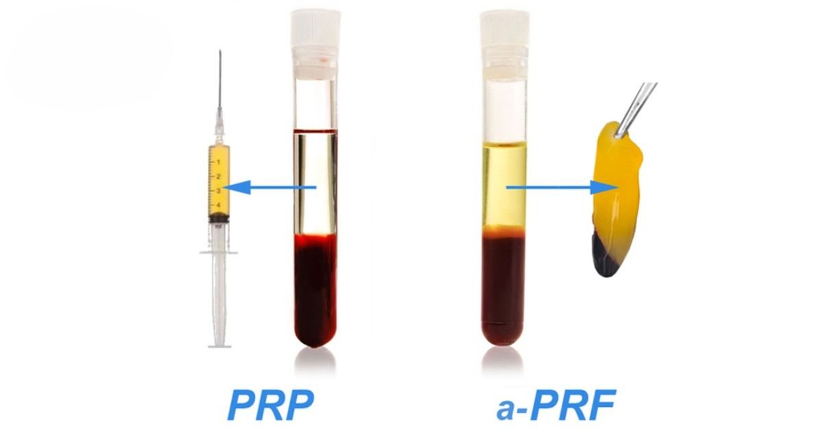 PRP và PRF có sự khác nhau về tính chất