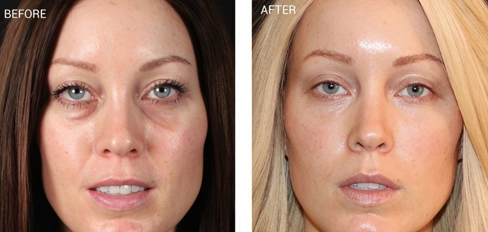 Kết quả tiêm PRF sẽ biểu hiện rõ rệt nhất sau khoảng 2 - 3 tháng