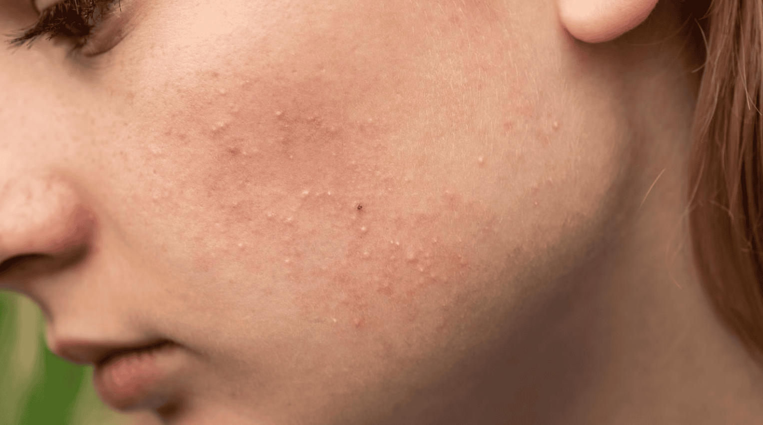 retinol có trị mụn không hình 2.png