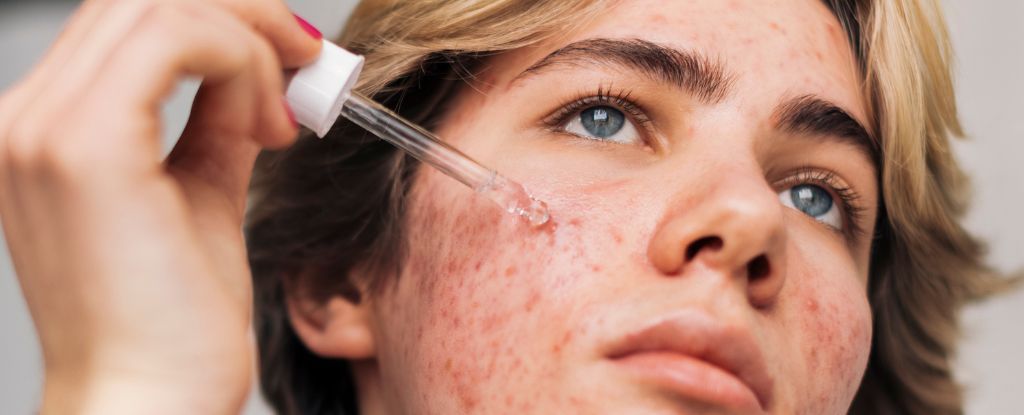 retinol có trị mụn không hình 4.jpg