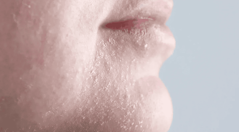 Hậu quả rõ ràng nhất của việc rửa mặt bằng nước nóng chính là tình trạng da khô nghiêm trọng, bong tróc và có cảm giác căng rát khó chịu