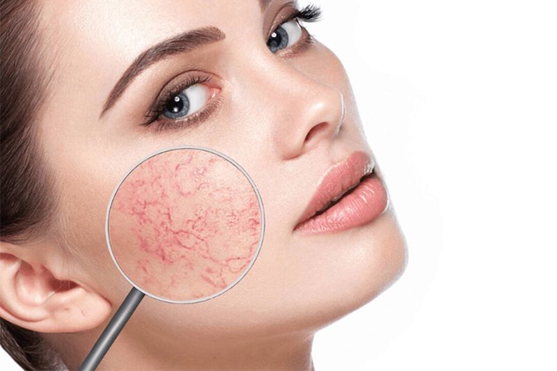 Nhiệt độ cao từ nước có thể làm giãn nở đột ngột các mạch máu nhỏ dưới da