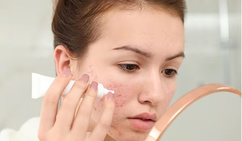 Sau khi làm sạch và sát khuẩn, nếu có, bạn nên thoa một lớp mỏng sản phẩm hỗ trợ phục hồi da mụn.
