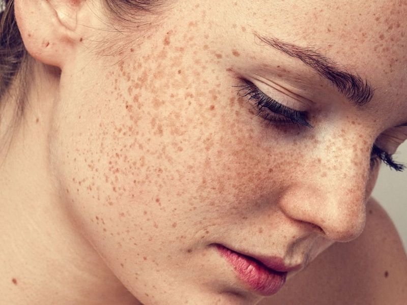Làn da có sắc tố không đều, dễ sạm nám cần chống nắng mạnh mẽ và hỗ trợ làm sáng