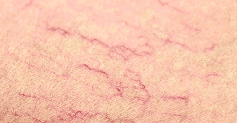 Giãn mao mạch là một hệ quả phổ biến khác, khi các mạch máu li ti dưới da bị giãn nở quá mức do Corticoid