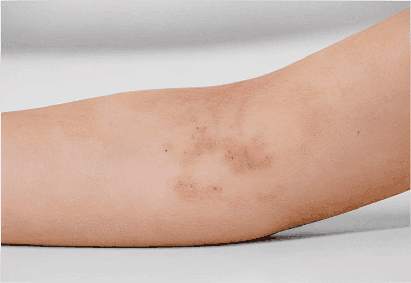 Viêm da kích ứng là phản ứng phổ biến nhất, thường xuất hiện khi da mới bắt đầu tiếp xúc với kem trộn